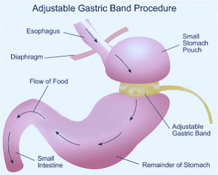 Virtual Gastric Band ~ Hypnosis: 4-session Reset of your relationship with  eating and food. — Eric Webster Lifestyle Engineer